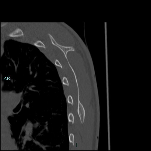 Avascular necrosis after fracture dislocations of the proximal humerus (Radiopaedia 88078-104653 Sagittal bone window 75).jpg