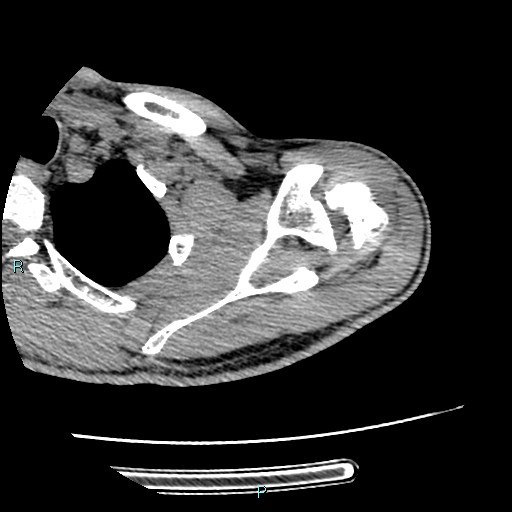 Avascular necrosis after fracture dislocations of the proximal humerus (Radiopaedia 88078-104655 D 38).jpg