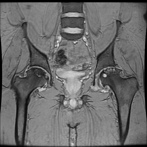 Avascular necrosis of the hip (Radiopaedia 61503-69465 F 49).jpg