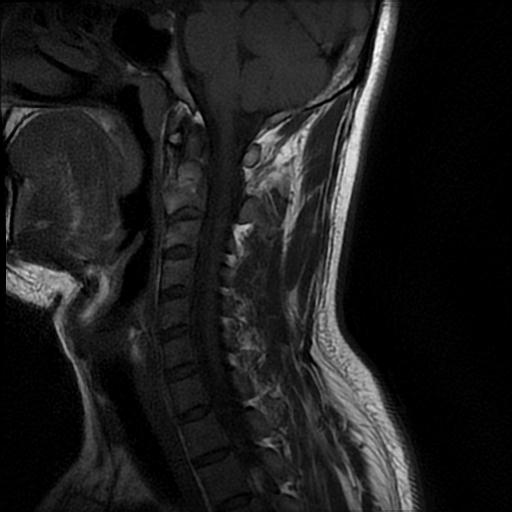 File:Axis fracture - MRI (Radiopaedia 71925-82375 Sagittal T1 6).jpg