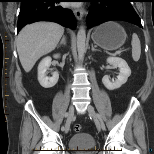 File:Bariatric balloon causing gastric outlet obstruction (Radiopaedia 54449-60672 B 36).jpg