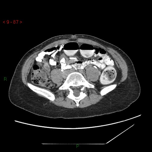 File:Bartholin gland cyst (Radiopaedia 54904-61181 Axial C+ delayed 22).jpg