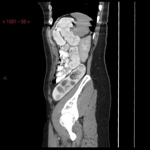 File:Bartholin gland cyst (Radiopaedia 54904-61181 Sagittal C+ delayed 38).jpg
