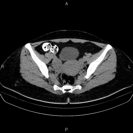 Bartholin gland cyst (Radiopaedia 62635-70930 Axial non-contrast 40).jpg