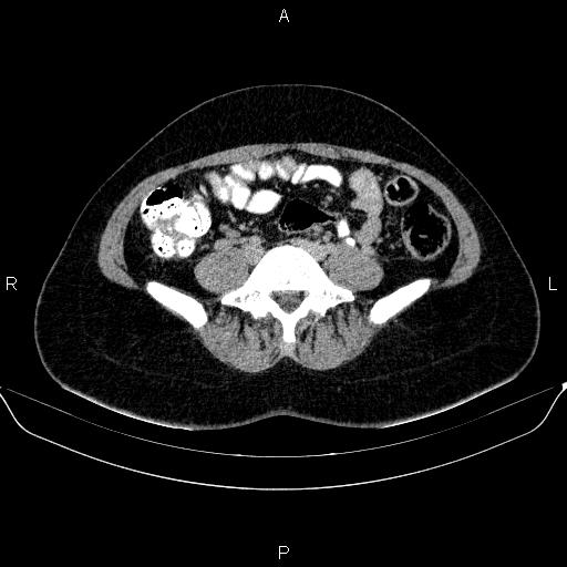Bartholin gland cyst (Radiopaedia 62635-70930 C 4).jpg