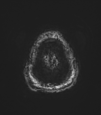 Basal ganglia hemorrhage - hypertensive (Radiopaedia 42227-45303 Axial SWI 86).png