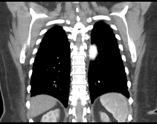 Basal ganglia metastasis (Radiopaedia 78928-91832 C 40).png