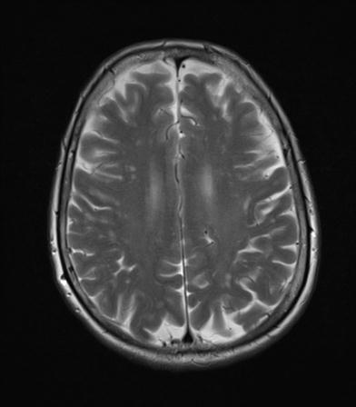 File:Base of skull chondrosarcoma (Radiopaedia 30410-31070 Axial T2 15).jpg