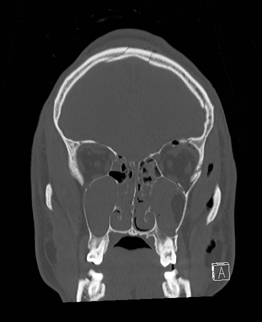 Base of skull fracture with bilateral Le Fort fractures (Radiopaedia 47094-51638 Coronal bone window 72).jpg