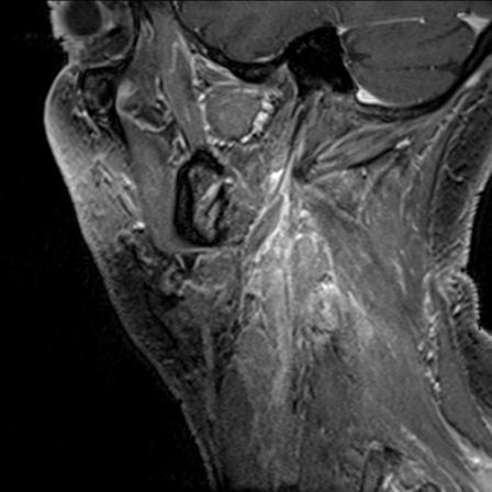 Base of tongue squamous cell carcinoma (Radiopaedia 31174-31884 F 38).jpg