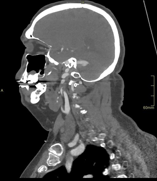 Basilar artery aneurysm (Radiopaedia 56261-62932 C 11).jpg