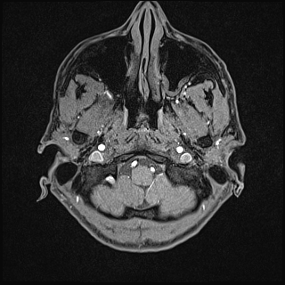 Basilar artery perforator aneurysm (Radiopaedia 82455-97733 Axial T1 fat sat 10).jpg