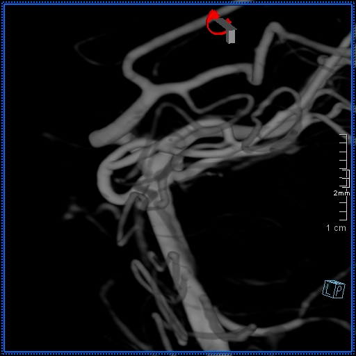 Basilar artery perforator aneurysm (Radiopaedia 82455-99524 3D Left VA 11).jpg