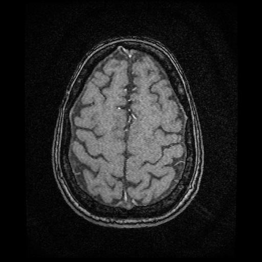 Basilar top and left middle cerebral artery aneurysm (Radiopaedia 61965-70031 Axial MRA 141).jpg
