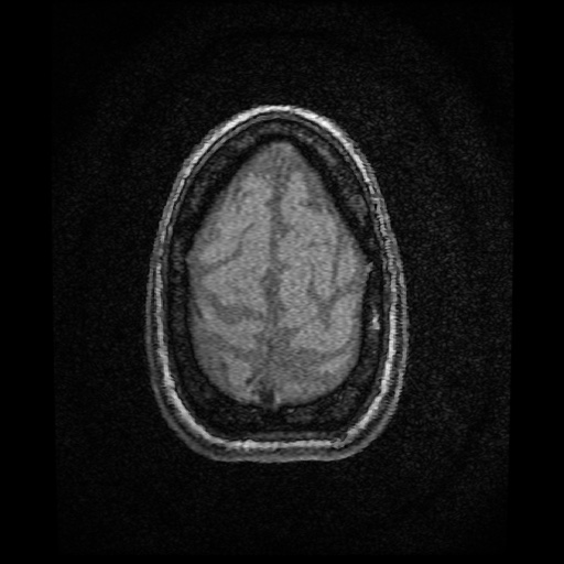 Basilar top and left middle cerebral artery aneurysm (Radiopaedia 61965-70031 Axial MRA 160).jpg