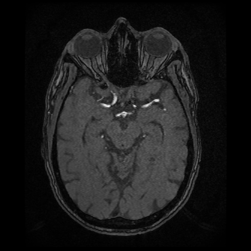 Basilar top and left middle cerebral artery aneurysm (Radiopaedia 61965-70031 Axial MRA 63).jpg