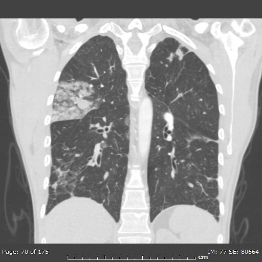 Behçet disease (Radiopaedia 44247-47889 Coronal lung window 19).jpg