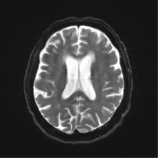 Behavioral variant frontotemporal dementia and late onset schizophrenia (Radiopaedia 52197-58083 Axial DTI Trace W 16).png