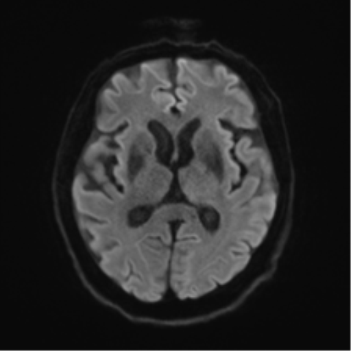Behavioral variant frontotemporal dementia and late onset schizophrenia (Radiopaedia 52197-58083 Axial DTI Trace W 41).png