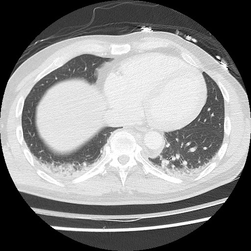 Benign post-traumatic pseudopneumoperitoneum (Radiopaedia 71199-81495 Axial lung window 52).jpg