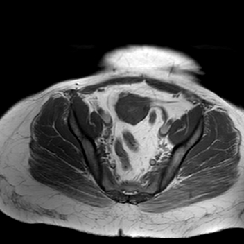 File:Benign seromucinous cystadenoma of the ovary (Radiopaedia 71065-81300 Axial T1 10).jpg