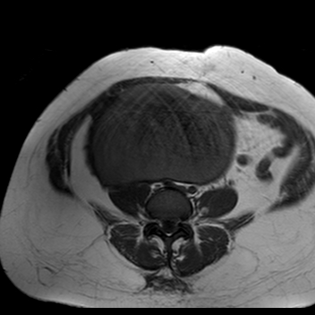 File:Benign seromucinous cystadenoma of the ovary (Radiopaedia 71065-81300 Axial T1 18).jpg