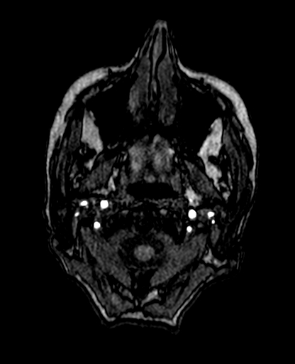 File:Berry aneurysm of the terminal internal carotid artery (Radiopaedia 88286-104918 Axial TOF 19).jpg