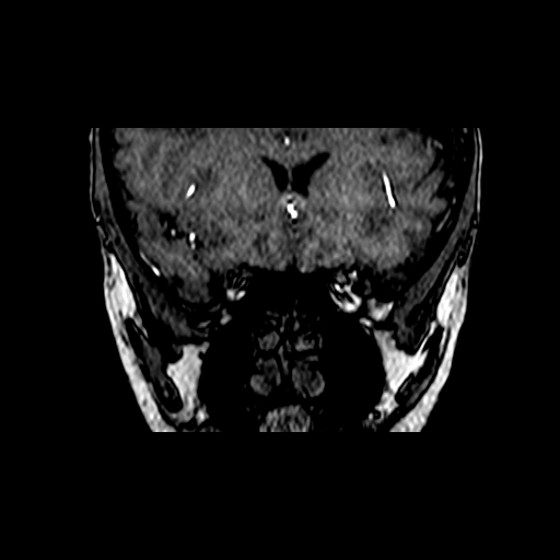 Berry aneurysm of the terminal internal carotid artery (Radiopaedia 88286-104918 Coronal TOF 20).jpg