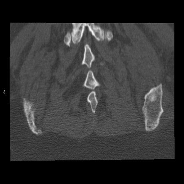 Bertolotti syndrome (Radiopaedia 24864-25128 Coronal bone window 44).jpg