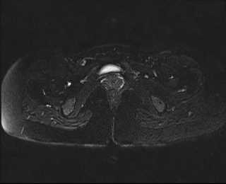File:Bicornuate bicollis uterus (Radiopaedia 61626-69616 Axial PD fat sat 31).jpg