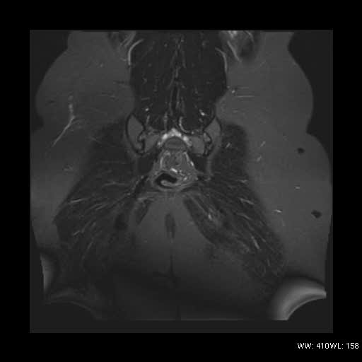 File:Bicornuate uterus- on MRI (Radiopaedia 49206-54297 Coronal STIR 18).jpg