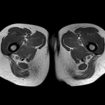 File:Bicornuate uterus (Radiopaedia 61974-70046 Axial T1 49).jpg