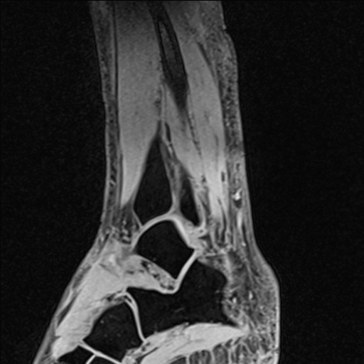 Bilateral Achilles tendon complete tear (Radiopaedia 81344-95051 Sagittal WE - Left 81).jpg