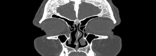 Bilateral Ectopic Infraorbital Nerves (Radiopaedia 49006-54084 Coronal bone window 8).jpg