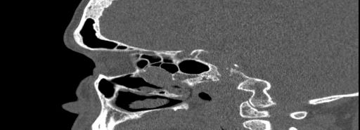 Bilateral Ectopic Infraorbital Nerves (Radiopaedia 49006-54084 Sagittal bone window 21).jpg