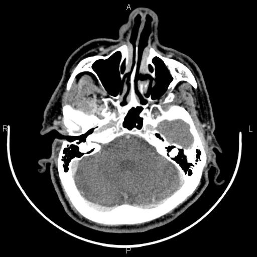 Bilateral Warthin tumors (Radiopaedia 84034-99263 Axial With contrast 6).jpg