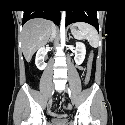 File:Bilateral accessory renal arteries with mild pelvi-ureteric junction (PUJ) obstruction (Radiopaedia 66357-75596 B 25).jpg