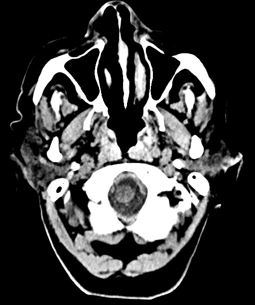 Bilateral acute on chronic subdural hematomas (Radiopaedia 78466-91146 Axial non-contrast 10).jpg