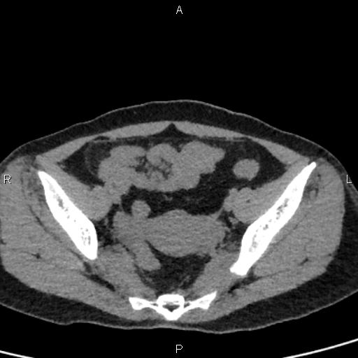 Bilateral adrenal gland hyperenhancement in pancreatitis (Radiopaedia 86642-102753 Axial non-contrast 93).jpg