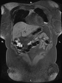 File:Bilateral adrenal myelolipoma (Radiopaedia 63058-71537 Coronal T1 fat sat 84).jpg