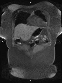 Bilateral adrenal myelolipoma (Radiopaedia 63058-71537 Coronal T1 fat sat 90).jpg