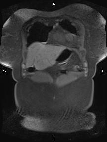 Bilateral adrenal myelolipoma (Radiopaedia 63058-71537 Coronal T1 fat sat 93).jpg