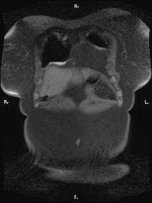 File:Bilateral adrenal myelolipoma (Radiopaedia 63058-71537 Coronal T1 fat sat 97).jpg