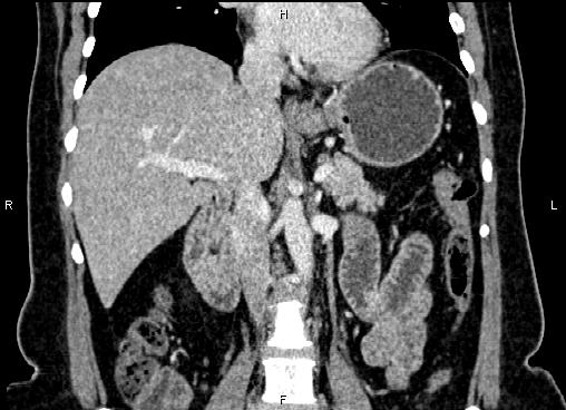 Bilateral benign adrenal adenomas (Radiopaedia 86912-103124 D 30).jpg