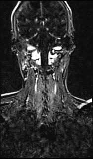 File:Bilateral carotid body tumors and right glomus jugulare tumor (Radiopaedia 20024-20060 MRA 125).jpg