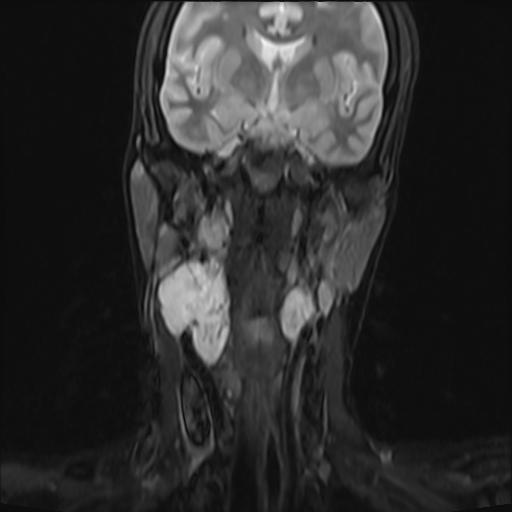 File:Bilateral carotid body tumors and right jugular paraganglioma (Radiopaedia 20024-20060 Coronal 26).jpg