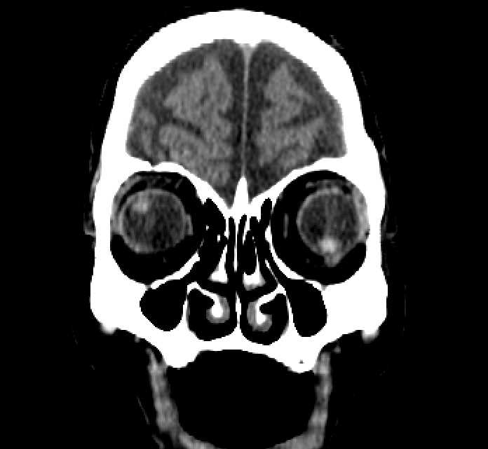 Bilateral ectopia lentis (Radiopaedia 89889-107013 Coronal non-contrast 41).jpg