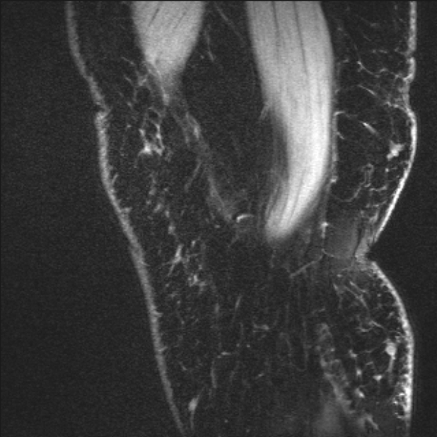 Bilateral focal pigmented villonodular synovitis (Radiopaedia 67643-77073 Sagittal T1 vibe 64).jpg