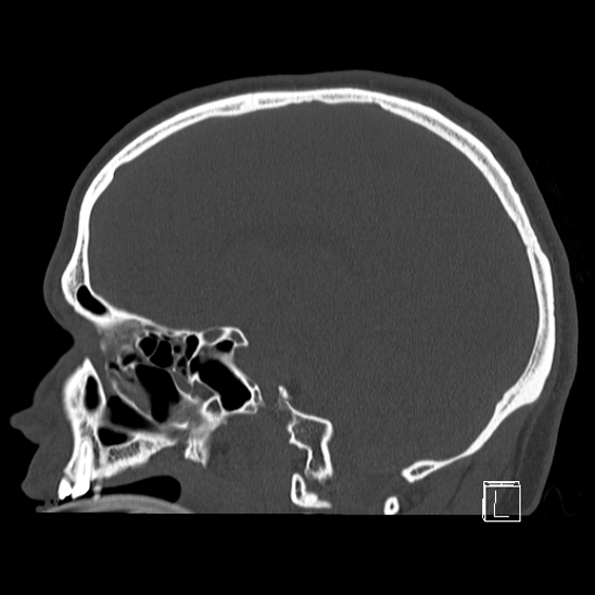 Bilateral occipital condyle fracture (type 2) (Radiopaedia 87675-104089 Sagittal bone window 44).jpg