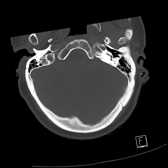 Bilateral occipital condyle fractures (type 3) (Radiopaedia 87672-104086 Axial bone window 2).jpg